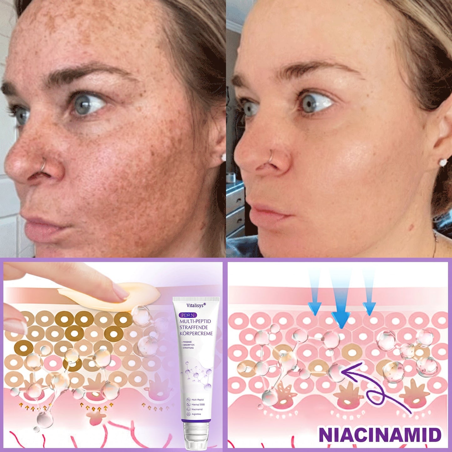 30 % DE RÉDUCTION🎁✨𝐕𝐢𝐭𝐚𝗹𝒊𝒔𝒚𝒔®  𝗣𝗗𝗥𝗡 𝐌𝐮𝗹𝘁𝗶-𝗣𝗲𝗽𝘁𝗶𝗱𝐞 𝐌𝐚𝐬𝐬𝐚𝐠𝐢𝐧𝐠 𝐁𝐨𝐝𝐲 𝐑𝐨𝐥𝐥𝐞𝐫 𝐂𝐫𝐞𝐚𝐦 — Anti-âge, Hydratant, Raffermissant & Liftant, Réparateur, Teint Unifié, Anti-Acné & Taches, Anti-Verrues & Grains de Beauté, Anti-Psoriasis.