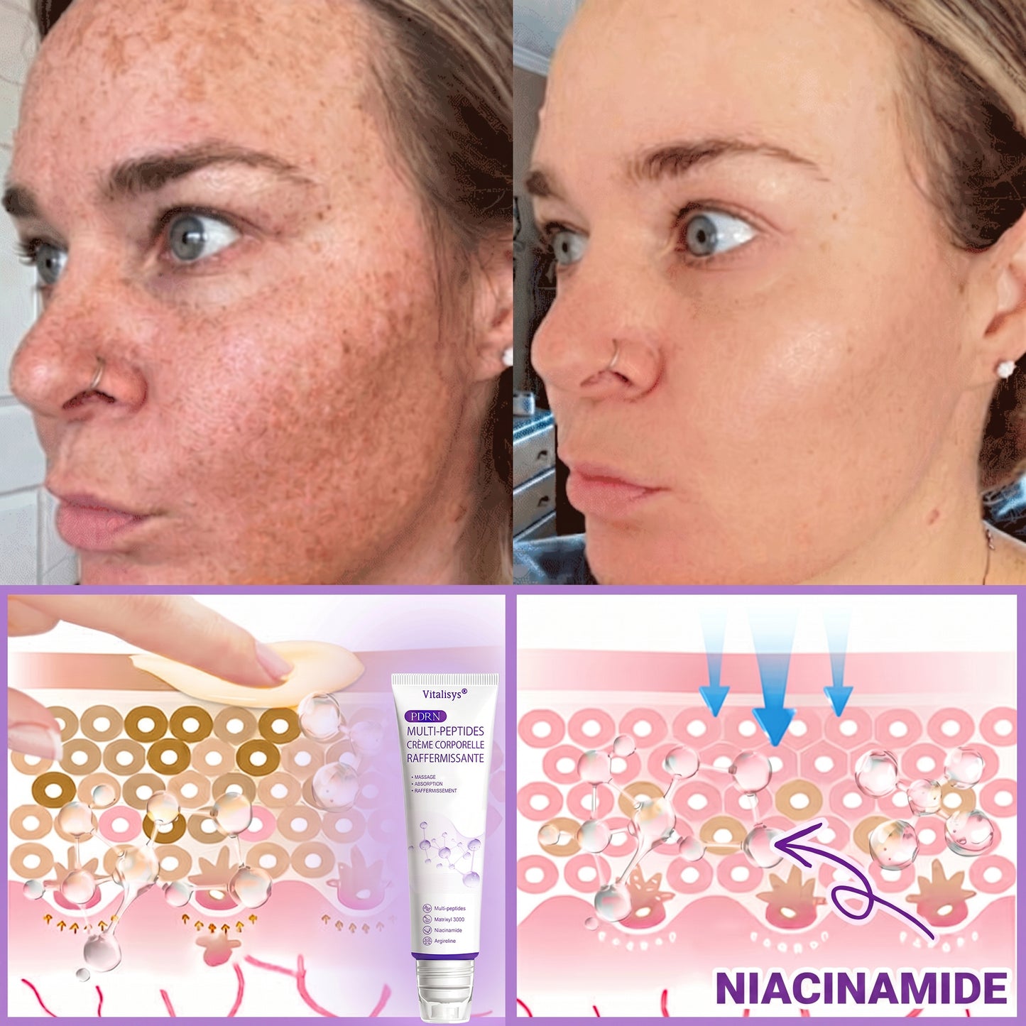 Boutique officielle✅ : Vitalisys® PDRN Crème Corps avec Roller ✨ – Anti-âge, hydratation, fermeté et régénération. Pour un teint unifié, traite acné, taches pigmentaires et verrues 🎁