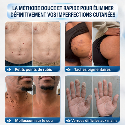 👩‍⚕️💯 𝘽𝙤𝙪𝙩𝙞𝒒𝒖𝒆 𝗢𝗳𝗳𝗶𝗰𝗶𝗲𝐥𝐥𝐞  | 𝑴𝑼𝑹𝑾𝑶𝑵® 🌿 𝑷𝒂𝒕𝒄𝒉𝒔 à 𝑴𝒊𝒄𝒓𝒐-𝒂𝒊𝒈𝒖𝒊𝒍𝒍𝒆𝒔 𝑨𝒏𝒕𝒊-𝑽𝒆𝒓𝒓𝒖𝒆𝒔 𝒆𝒕 𝑷𝒆𝒂𝒖 𝑵𝒆𝒕𝒕𝒆 (𝘗𝘰𝘶𝘳 𝘢𝘤𝘳𝘰𝘤𝘩𝘰𝘳𝘥𝘰𝘯𝘴, 𝘦𝘹𝘤𝘳𝘰𝘪𝘴𝘴𝘢𝘯𝘤𝘦𝘴 𝘤𝘶𝘵𝘢𝘯é𝘦𝘴, 𝘨𝘳𝘢𝘪𝘯𝘴 𝘥𝘦 𝘣𝘦𝘢𝘶𝘵é, 𝘵𝘢𝘤𝘩𝘦𝘴 𝘥𝘦 𝘷𝘪𝘦𝘪𝘭𝘭𝘦𝘴𝘴𝘦 𝘦𝘵 𝘱𝘪𝘨𝘮𝘦𝘯𝘵𝘢𝘵𝘪𝘰𝘯)🏵️