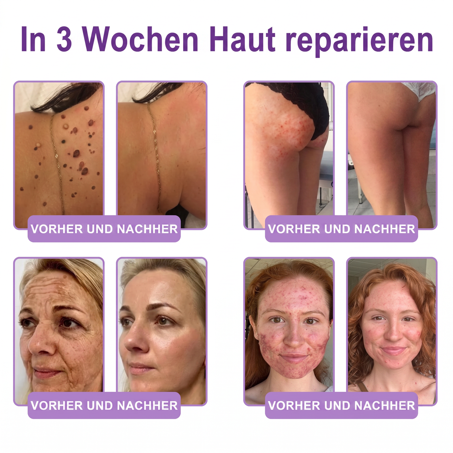 30 % DE RÉDUCTION🎁✨𝐕𝐢𝐭𝐚𝗹𝒊𝒔𝒚𝒔®  𝗣𝗗𝗥𝗡 𝐌𝐮𝗹𝘁𝗶-𝗣𝗲𝗽𝘁𝗶𝗱𝐞 𝐌𝐚𝐬𝐬𝐚𝐠𝐢𝐧𝐠 𝐁𝐨𝐝𝐲 𝐑𝐨𝐥𝐥𝐞𝐫 𝐂𝐫𝐞𝐚𝐦 — Anti-âge, Hydratant, Raffermissant & Liftant, Réparateur, Teint Unifié, Anti-Acné & Taches, Anti-Verrues & Grains de Beauté, Anti-Psoriasis.