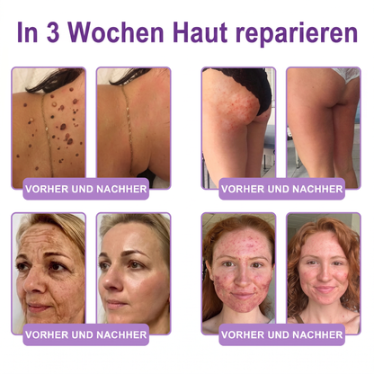 30 % DE RÉDUCTION🎁✨𝐕𝐢𝐭𝐚𝗹𝒊𝒔𝒚𝒔®  𝗣𝗗𝗥𝗡 𝐌𝐮𝗹𝘁𝗶-𝗣𝗲𝗽𝘁𝗶𝗱𝐞 𝐌𝐚𝐬𝐬𝐚𝐠𝐢𝐧𝐠 𝐁𝐨𝐝𝐲 𝐑𝐨𝐥𝐥𝐞𝐫 𝐂𝐫𝐞𝐚𝐦 — Anti-âge, Hydratant, Raffermissant & Liftant, Réparateur, Teint Unifié, Anti-Acné & Taches, Anti-Verrues & Grains de Beauté, Anti-Psoriasis.