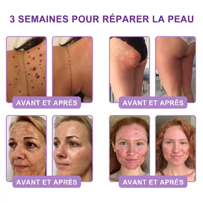 Boutique officielle✅ : Vitalisys® PDRN Crème Corps avec Roller ✨ – Anti-âge, hydratation, fermeté et régénération. Pour un teint unifié, traite acné, taches pigmentaires et verrues 🎁