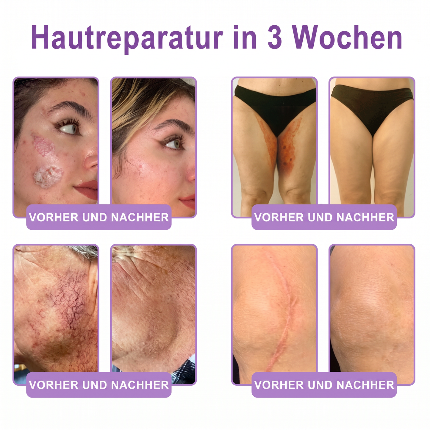 30 % DE RÉDUCTION🎁✨𝐕𝐢𝐭𝐚𝗹𝒊𝒔𝒚𝒔®  𝗣𝗗𝗥𝗡 𝐌𝐮𝗹𝘁𝗶-𝗣𝗲𝗽𝘁𝗶𝗱𝐞 𝐌𝐚𝐬𝐬𝐚𝐠𝐢𝐧𝐠 𝐁𝐨𝐝𝐲 𝐑𝐨𝐥𝐥𝐞𝐫 𝐂𝐫𝐞𝐚𝐦 — Anti-âge, Hydratant, Raffermissant & Liftant, Réparateur, Teint Unifié, Anti-Acné & Taches, Anti-Verrues & Grains de Beauté, Anti-Psoriasis.