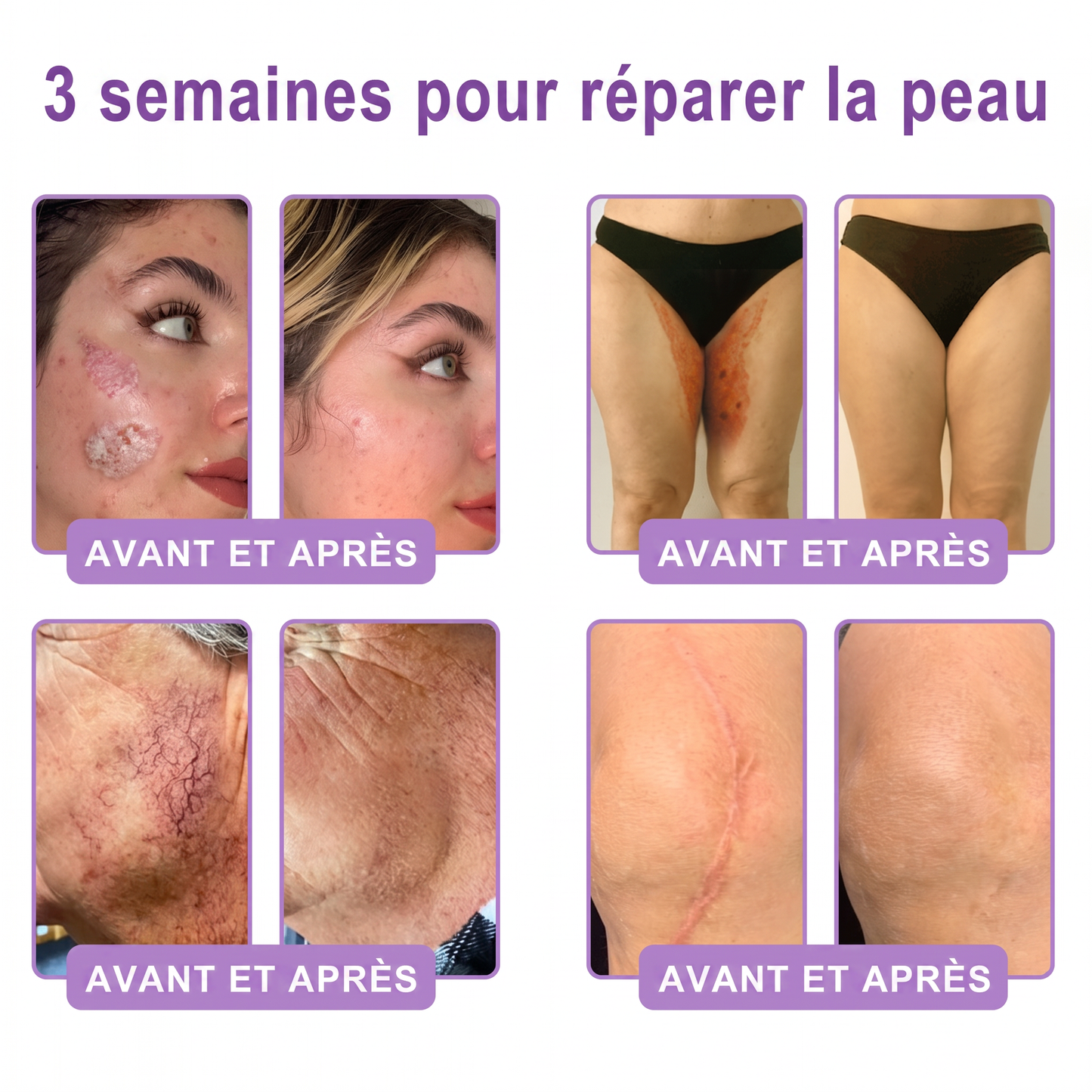 Boutique officielle✅ : Vitalisys® PDRN Crème Corps avec Roller ✨ – Anti-âge, hydratation, fermeté et régénération. Pour un teint unifié, traite acné, taches pigmentaires et verrues 🎁