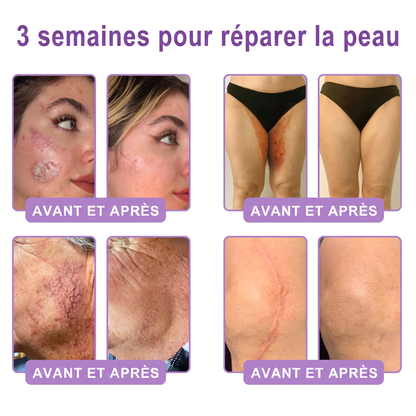 Boutique officielle✅ : Vitalisys® PDRN Crème Corps avec Roller ✨ – Anti-âge, hydratation, fermeté et régénération. Pour un teint unifié, traite acné, taches pigmentaires et verrues 🎁